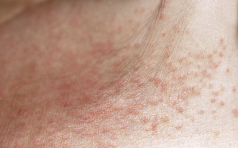 How To Prevent Heat Rash /  Prickly Heat